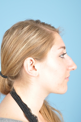 Rhinoplasty Before & After Image