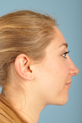 Rhinoplasty Before & After Image