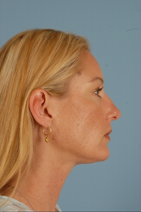 Rhinoplasty Before & After Image