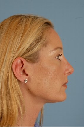 Rhinoplasty Before & After Image