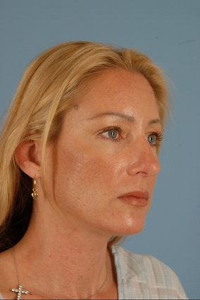 Rhinoplasty Before & After Image