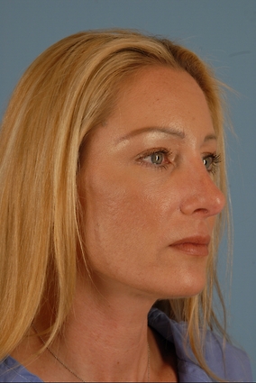 Rhinoplasty Before & After Image