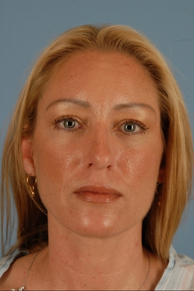 Rhinoplasty Before & After Image