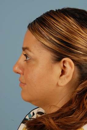 Rhinoplasty Before & After Image