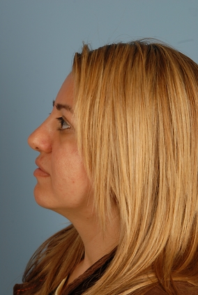 Rhinoplasty Before & After Image