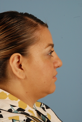 Rhinoplasty Before & After Image