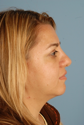 Rhinoplasty Before & After Image