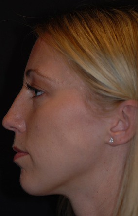 Rhinoplasty Before & After Image