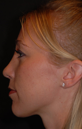 Rhinoplasty Before & After Image