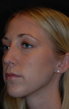 Rhinoplasty Before & After Image