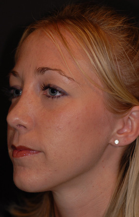 Rhinoplasty Before & After Image