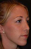 Rhinoplasty Before & After Image