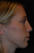 Rhinoplasty Before & After Image