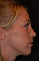 Rhinoplasty Before & After Image