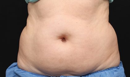 CoolSculpting Before & After Image