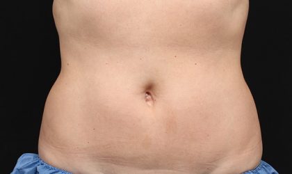 CoolSculpting Before & After Image