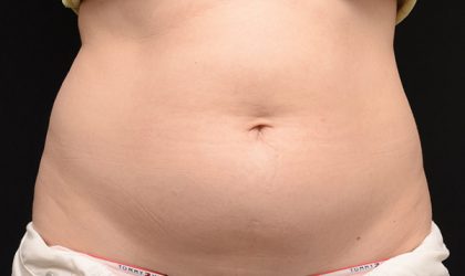 CoolSculpting Before & After Image