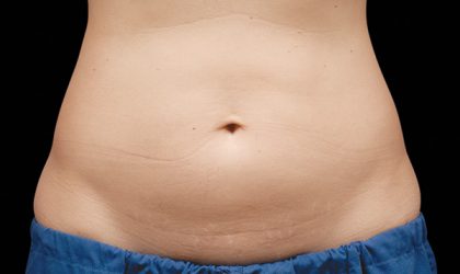 CoolSculpting Before & After Image