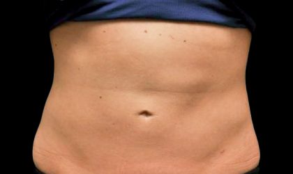 CoolSculpting Before & After Image