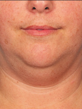 Injectables Before & After Image