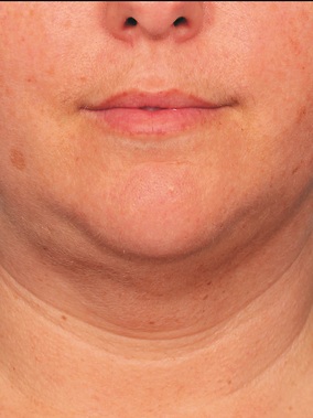 Injectables Before & After Image