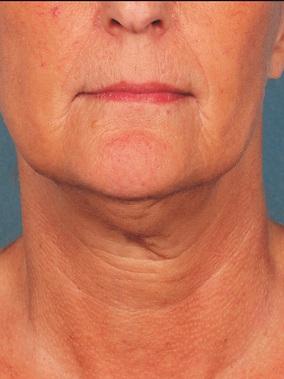 Injectables Before & After Image