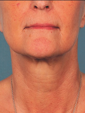 Injectables Before & After Image