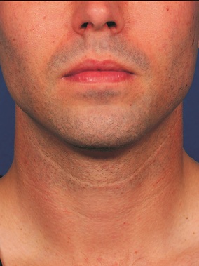 Injectables Before & After Image