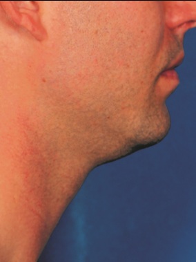 Kybella Before & After Image