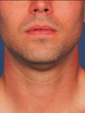 Kybella Before & After Image