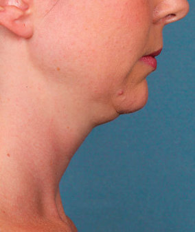 Kybella Before & After Image