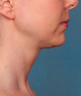 Kybella Before & After Image