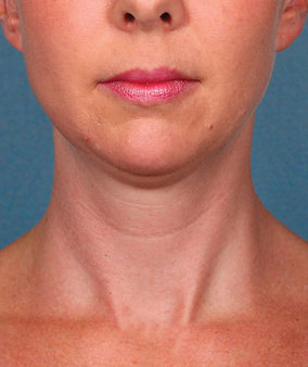 Kybella Before & After Image
