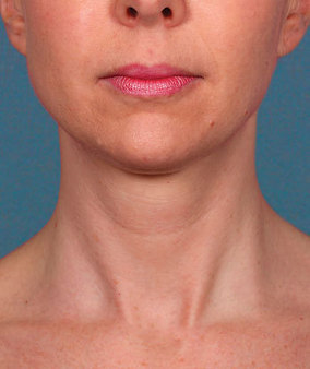 Kybella Before & After Image