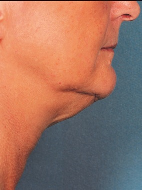 Kybella Before & After Image