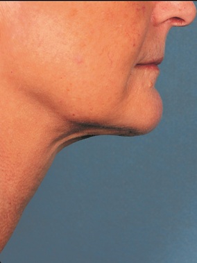 Kybella Before & After Image