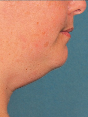 Kybella Before & After Image