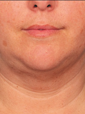Kybella Before & After Image
