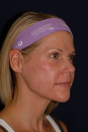 Laser Resurfacing Before & After Image