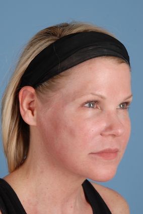 Laser Resurfacing Before & After Image