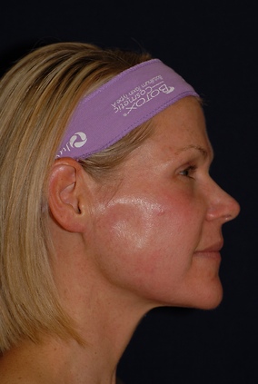 Laser Resurfacing Before & After Image