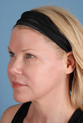 Laser Resurfacing Before & After Image