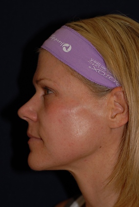 Laser Resurfacing Before & After Image