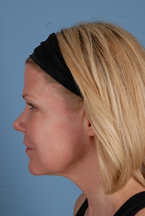 Laser Resurfacing Before & After Image