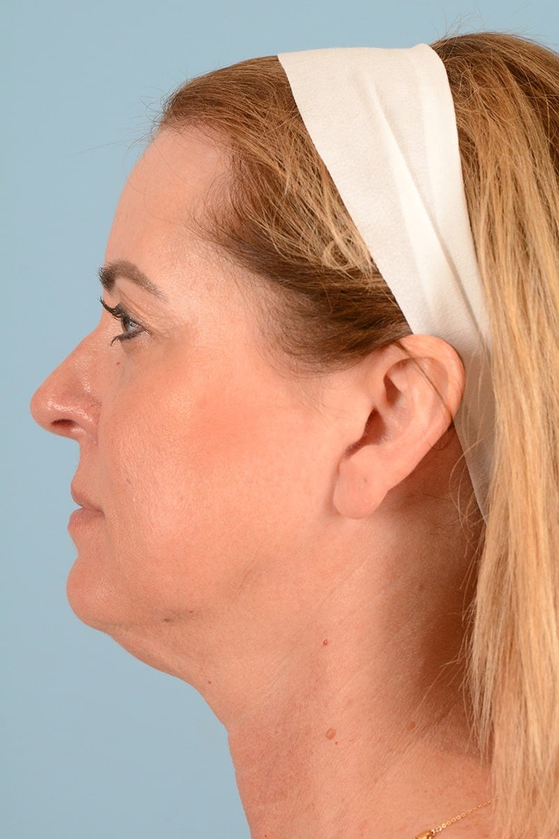 Laser Resurfacing Before & After Image