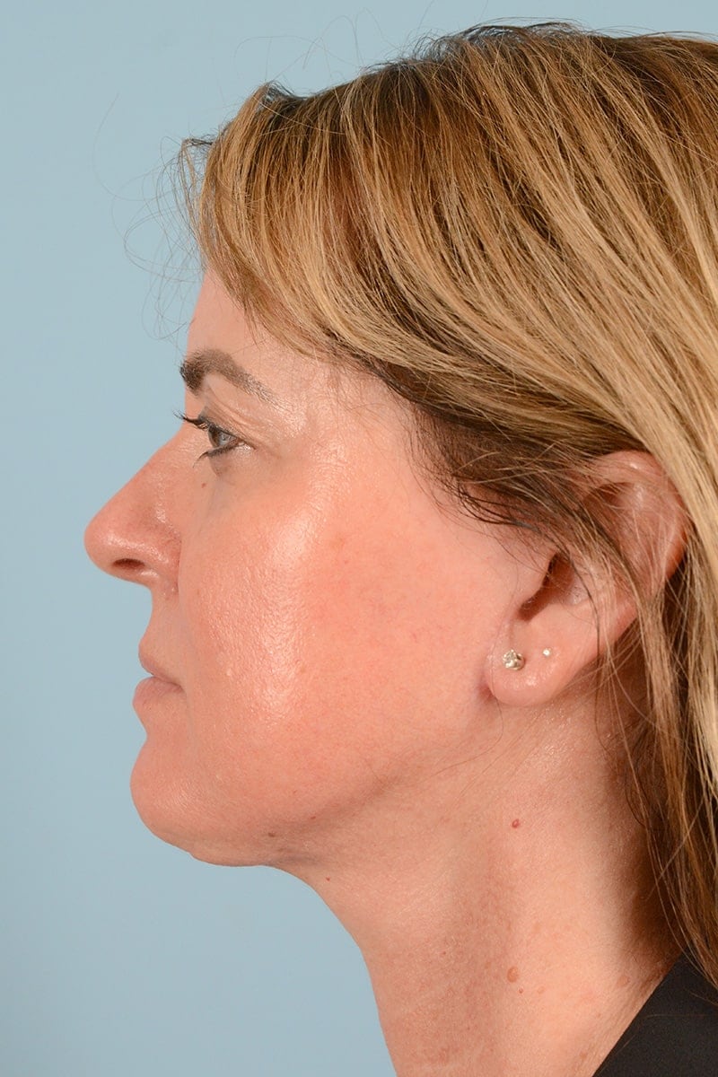 Laser Resurfacing Before & After Image