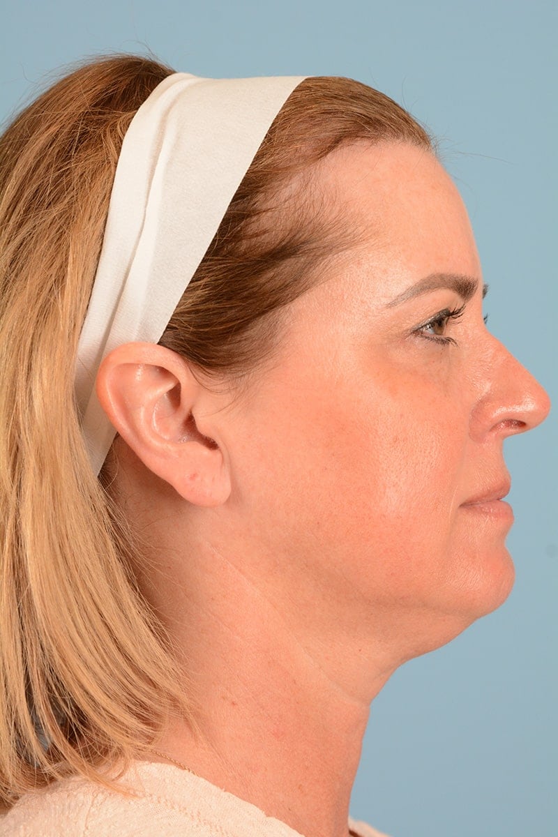 Laser Resurfacing Before & After Image