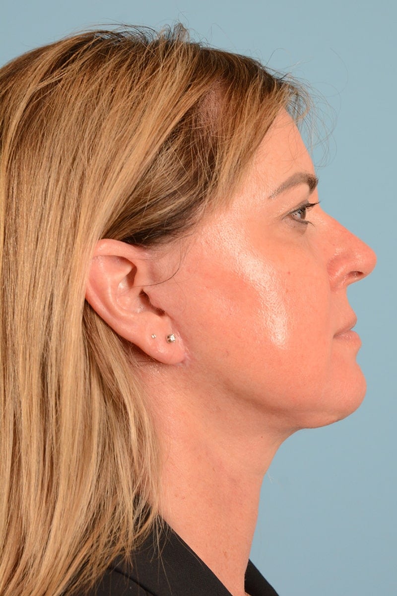 Laser Resurfacing Before & After Image