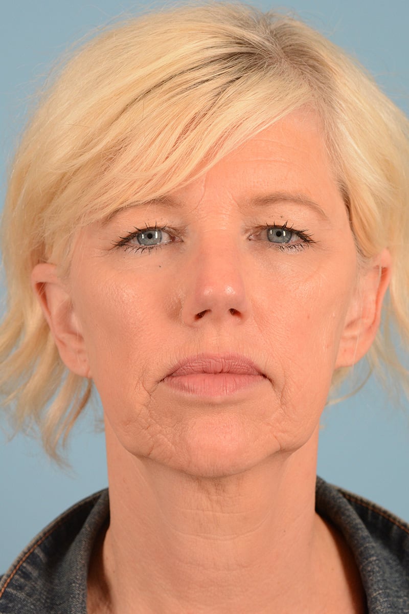 Laser Resurfacing Before & After Image