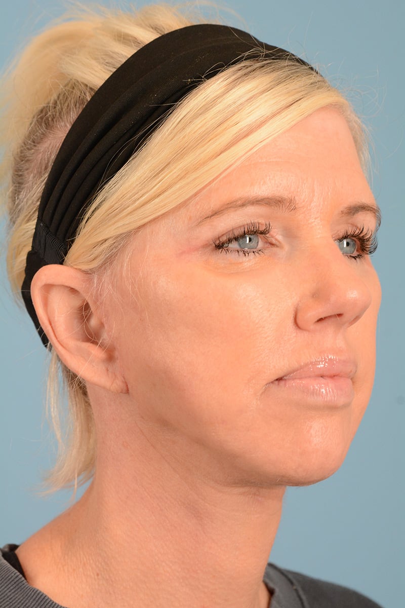 Laser Resurfacing Before & After Image